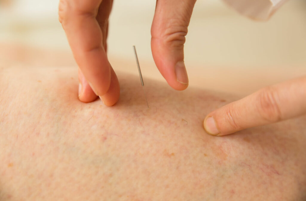 A close-up of an acupuncture practitioner placing a thin acupuncture needle in a person's skin.