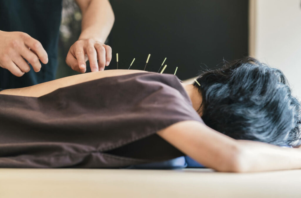 A young woman lying down comfortably during an acupuncture treatment session.