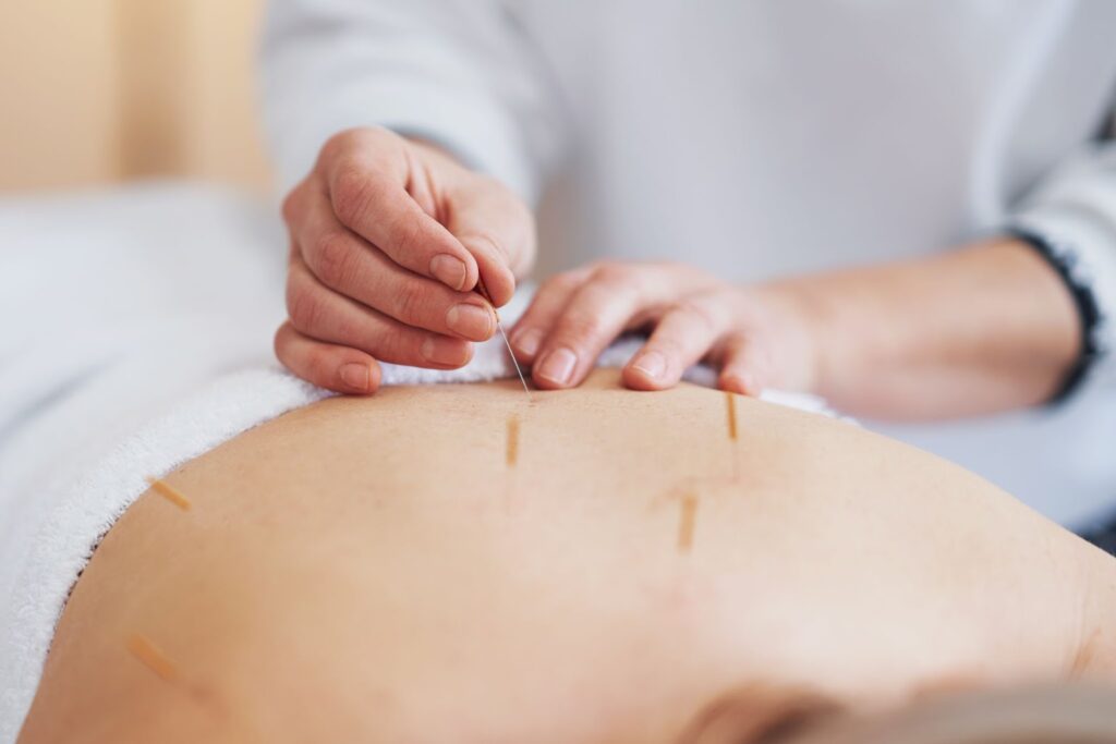 Image of a person's back getting acupuncture.
