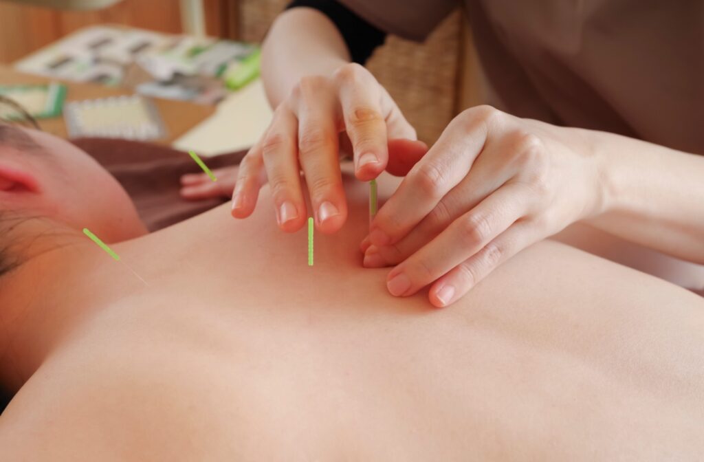 Someone laying down receiving acupuncture treatment.